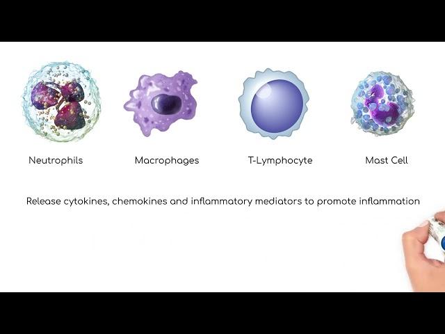 Pathophysiology: Chronic Obstructive Pulmonary Disease (COPD)