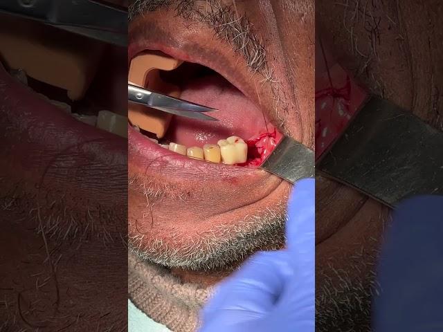 What Do Stitches Look Like?