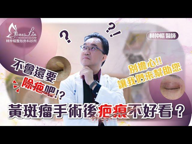 【美貌知尋識 ep49-黃斑瘤手術後疤痕不好看？】切除黃斑瘤疤痕會很難看嗎　#黃斑瘤 #台北黃斑瘤 #台北整外