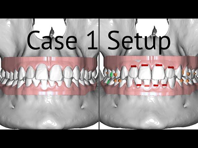 Maestro 3D aligners virtual setup: case 1, anterior crowding