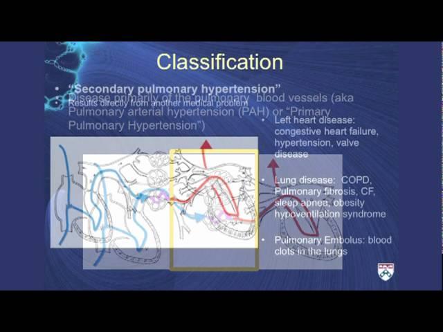 Pulmonary Hypertension: A challenging cause of shortness of breath