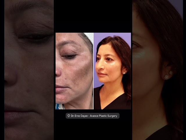 Advanced Skincare Treatment For Pigmentation | Avance Plastic Surgery Institute: Dr. Erez Dayan