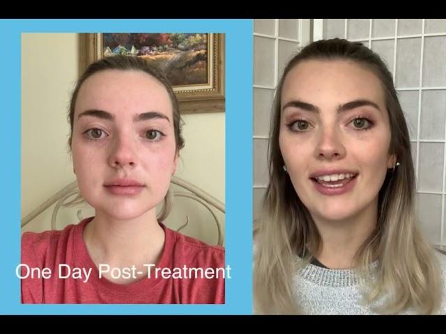 LM Buccal Fat Removal Testimonial