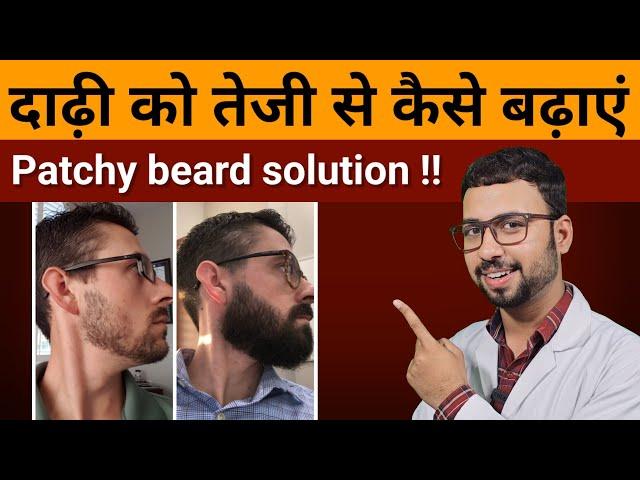 Patchy beard solution | patchy beard growth | How to grow patchy beard | How to grow beard faster
