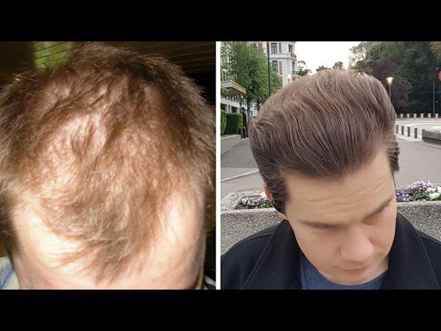 How To Distinguish Between Androgenetic Alopecia And Telogen Effluvium