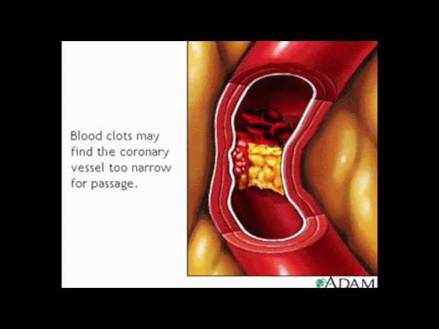 Coronary Artery Disease (CAD) Animation - MADE EASY