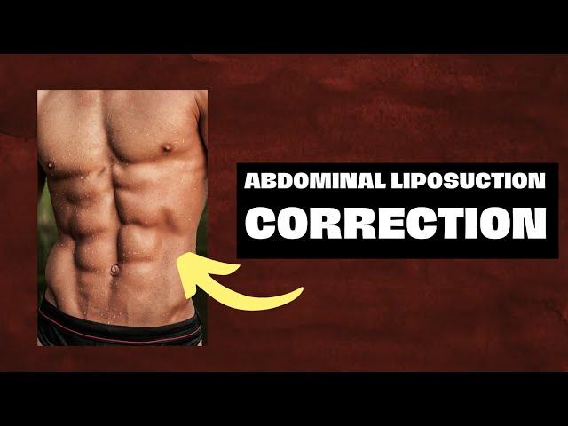 Abdominal Ab Etching Liposuction Correction with Release and Fat Grafting