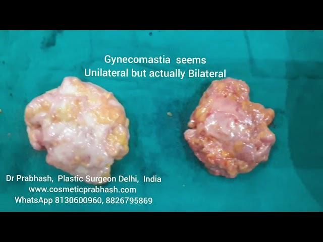 Gynecomastia surgery one side or both side Dr Prabhash Delhi