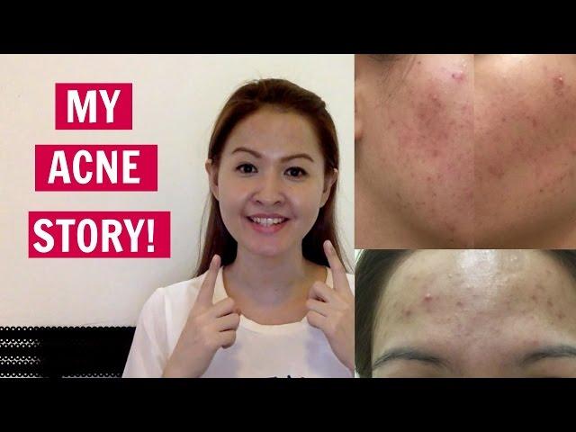 My Acne Story (with pictures)