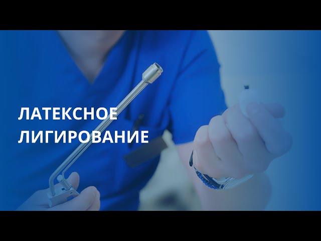 Латексное лигирование