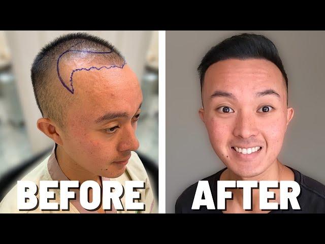 $4000 Thai Hair Transplant!! Success or Regret??