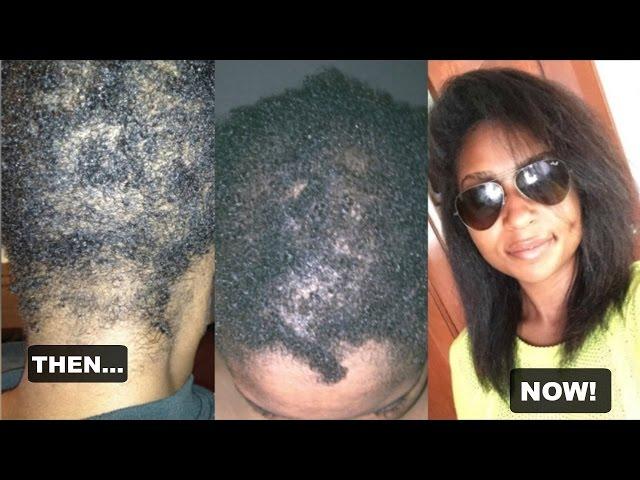 My Hair Loss: Alopecia Areata | JaMexicanBeauty | iamLindaElaine