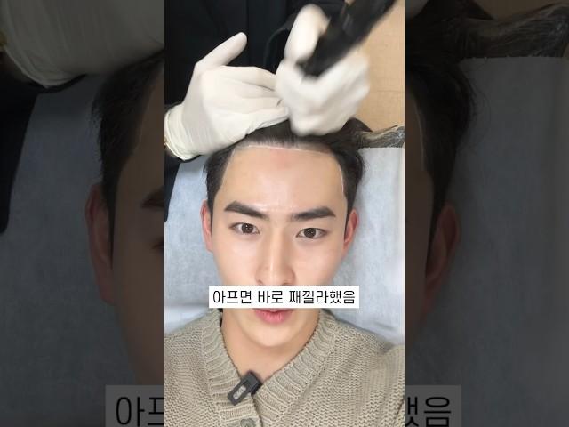 M자 탈모 있는 분들.. 진짜 한 번 고민해 보세요