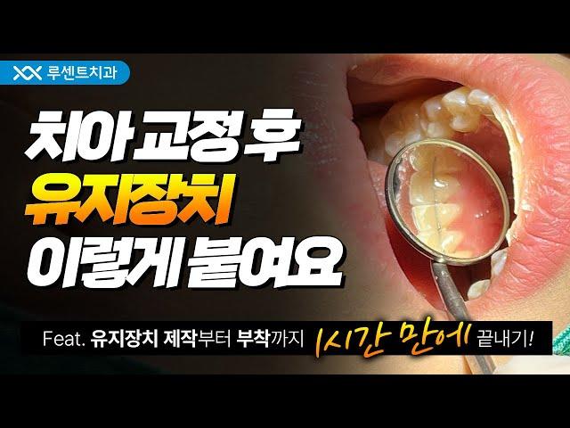 교정이 끝나도 끝난게 아니다? 교정 유지 장치 부착과정 | Feat. 제작부터 부착까지 1시간!