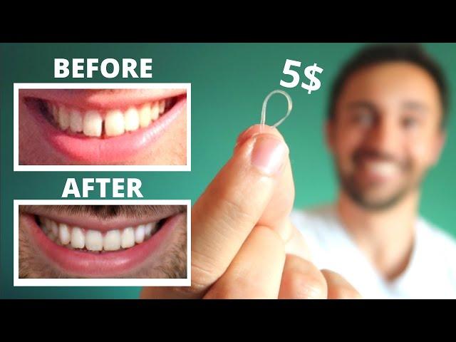 DIY: CLOSE GAP TEETH AT HOME || My Update