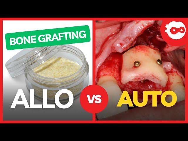 Allo vs Autograft for Dental Implants