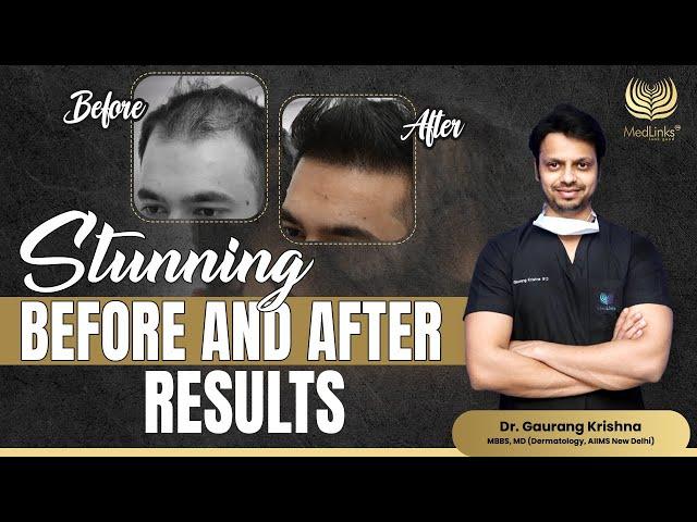 Stunning Before and After Results | Hair Transplant 2024 | MedLinks