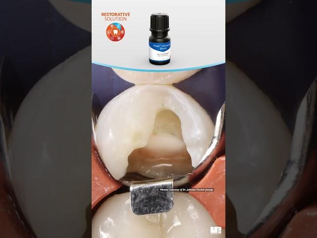 Ultradent Product's Restorative Solution | Case 2