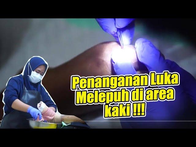 Perawatan luka yang melepuh di are kaki !!