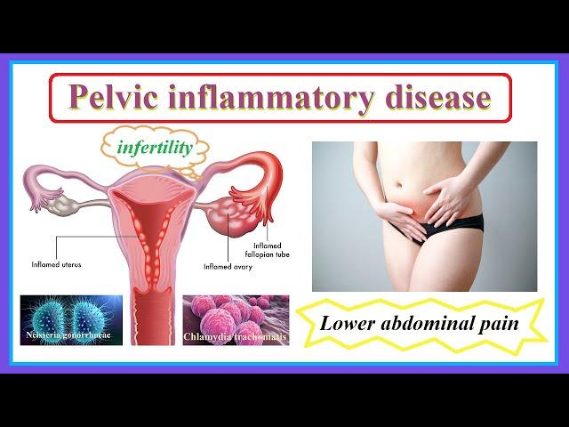 pelvic inflammatory disease