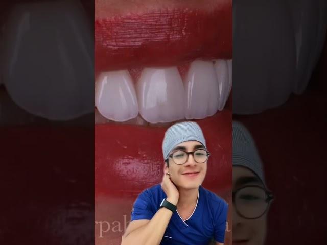 ASÍ ES COMO LOS FAMOSOS ESCOGEN SUS CARILLAS  #dentista