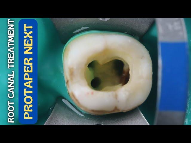 Root Canal Treatment in Mandibular Molar ️ Protaper Next  Step By Step Demonstration