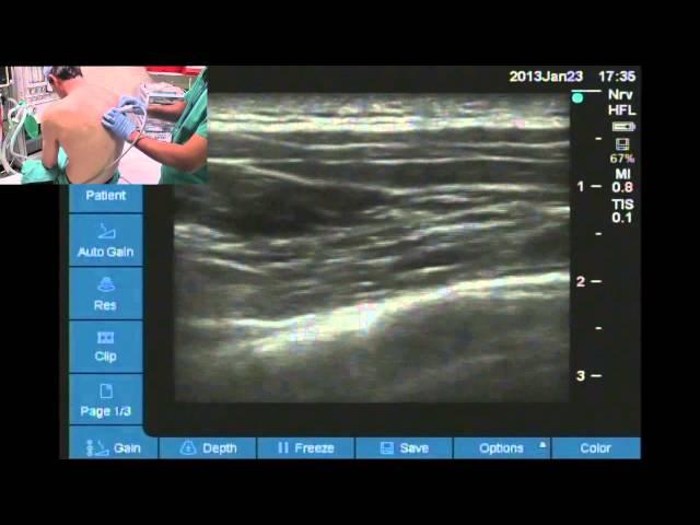 Ultrasound guided thoracic paravertebral space location