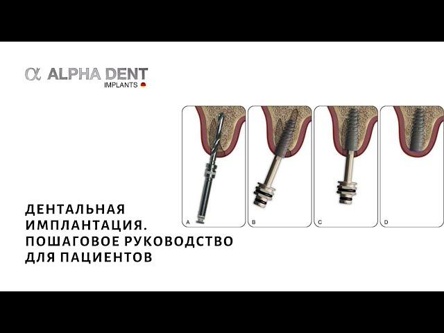 Дентальная имплантация. Пошаговое руководство для пациентов
