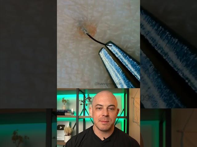 Doctor reacts to massive ingrown hair removal! #dermreacts #doctorreacts #ingrownhair