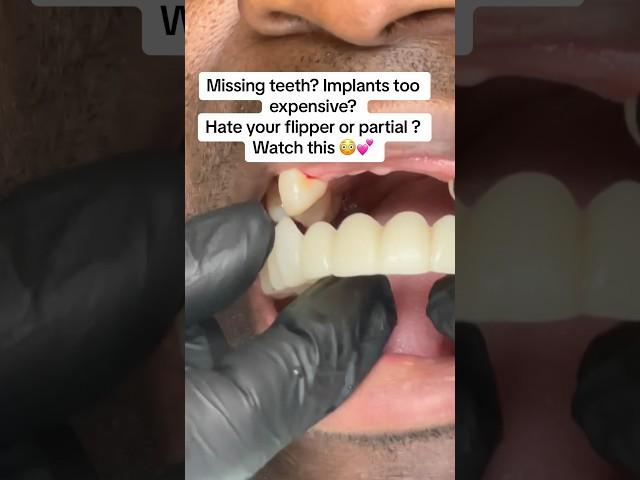 Got missing teeth? Hate your partial? Can't afford implants? Watch this !