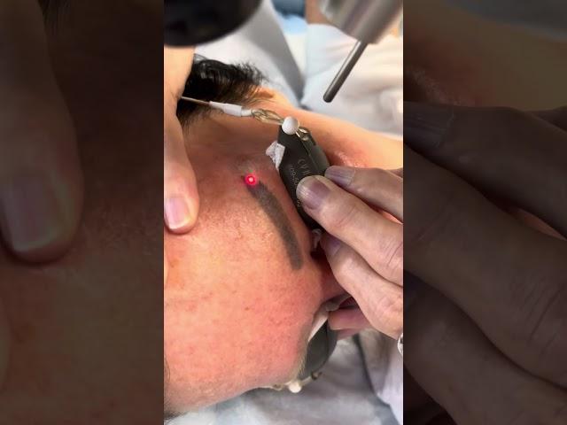 Removing tattooed eyebrows