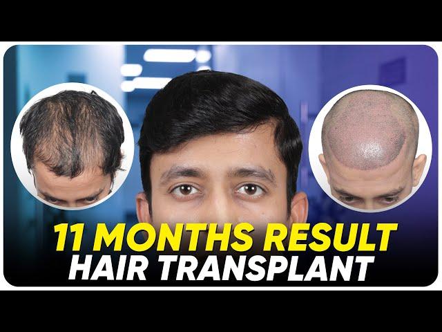 FUE Hair Transplant | Best Cost & Results of FUE Hair Transplant