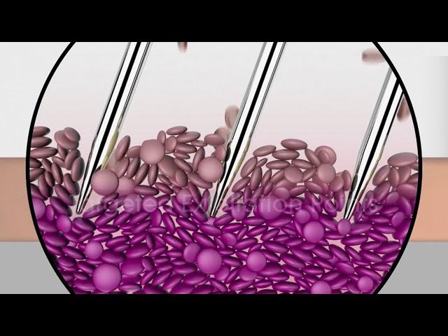 How microneedling works