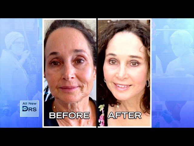 See Woman’s Incredible Before and After Facial Rejuvenation!