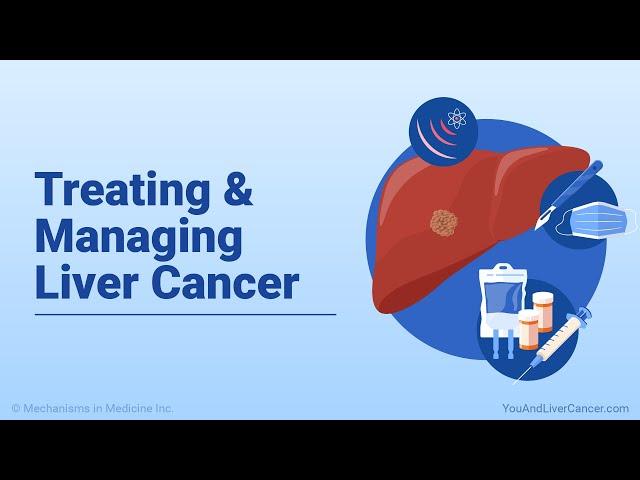 Treating and Managing Liver Cancer