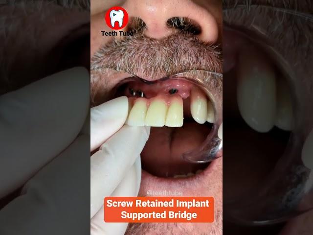 Screw Retained Implant Supported Bridge #shorts