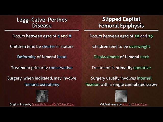 Legg–Calve–Perthes Disease vs. Slipped Capital Femoral Epiphysis