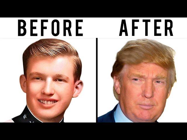 Donald Trump's Hair Transplant | Plastic Surgery Analysis