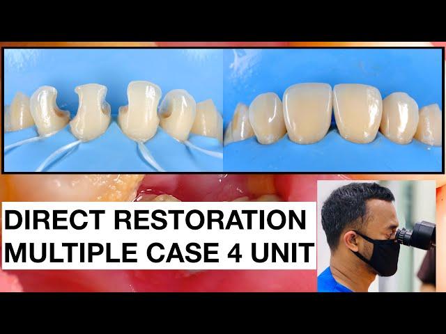 Direct Restoration Multiple Case | 2x SPEED | Tambal Gigi | Dokter Gigi Griya RR