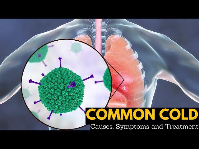 Common Cold, Causes, Signs and Symptoms, Diagnosis and Treatment.