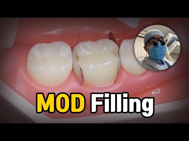 Dental Filling Procedure - MOD Molar Composite Restoration