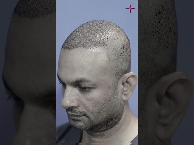 Long-Lasting Results: The Remarkable Journey of 5.5-Year Hair Transplant Results