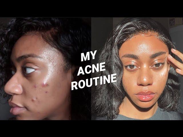 HOW I CLEARED MY ACNE using Korean Skincare Products | Medicube