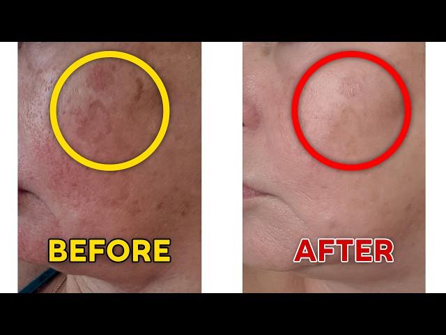 Red Light Therapy For Face Before And After: UNBELIEVABLE!