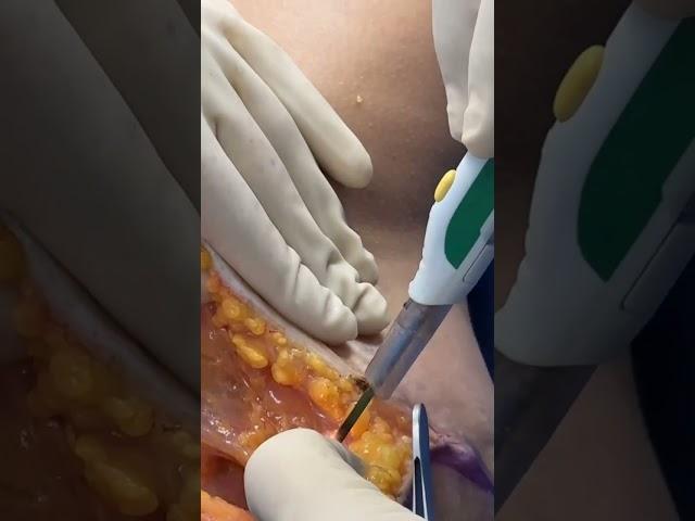 TRANSUMBILICAL SILICONE BOOB JOB & ABDOMINOPLASTY BY DR GABRIEL PATINO 12 23 2024.(510)525-7999