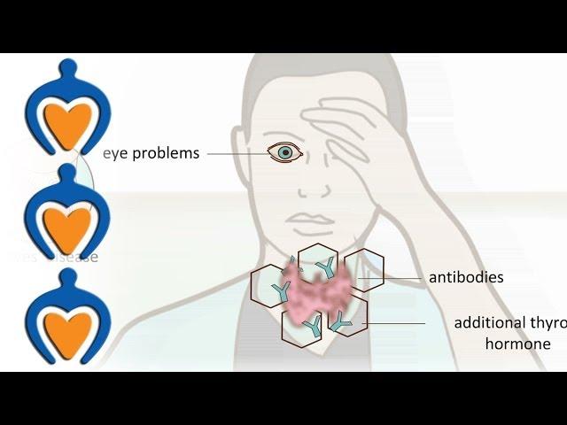 Thyroid problems - most common thyroid problems, symptoms and treatment