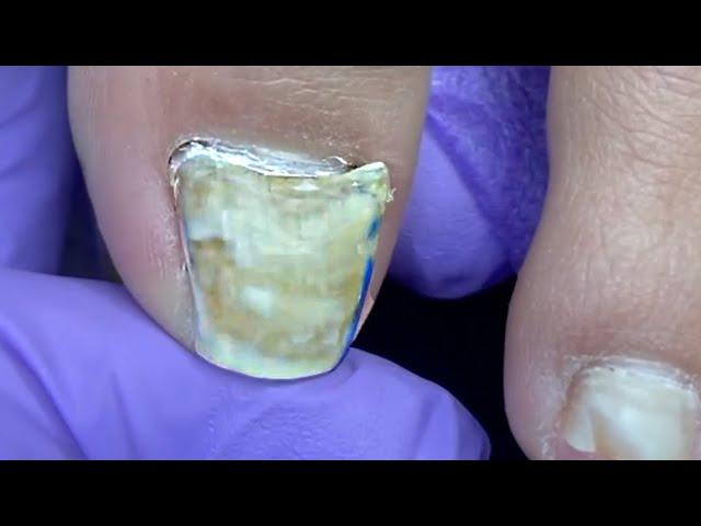 LOST the TOENAIL 