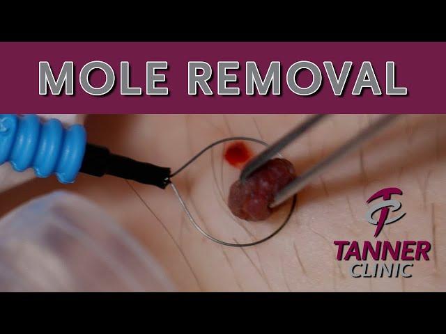 Mole Removal Plus After Care Information with Scott Beckstead, DO at our Farmington Tanner Clinic