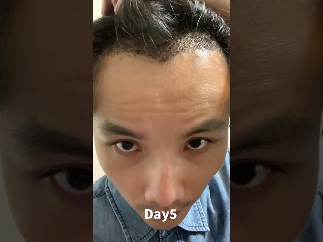 240天植髮紀錄｜240days hair transplant