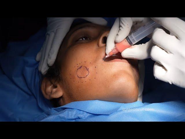 Fat grafting | Facial fat grafting | Surgical procedure